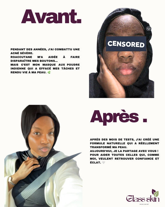 Comment j’ai vaincu mes imperfections après 8 ans d’acné – et pourquoi j’ai créé mon masque aux poudres indiennes